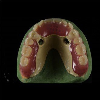 Gigi Palsu Kerangka Peek