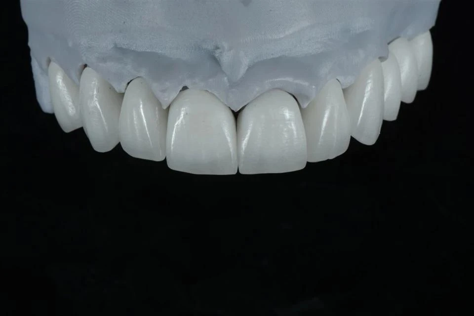 CAD/CAM Milled Zirconia Crowns CAD/CAM Milled Zirconia Crowns