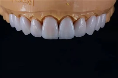 Venir Lapisan Ultra-Nipis E.max
